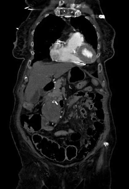 Abdominal aortic aneurysm with thrombus fissuration (Radiopaedia 73192-83919 Coronal C+ arterial phase 13).jpg