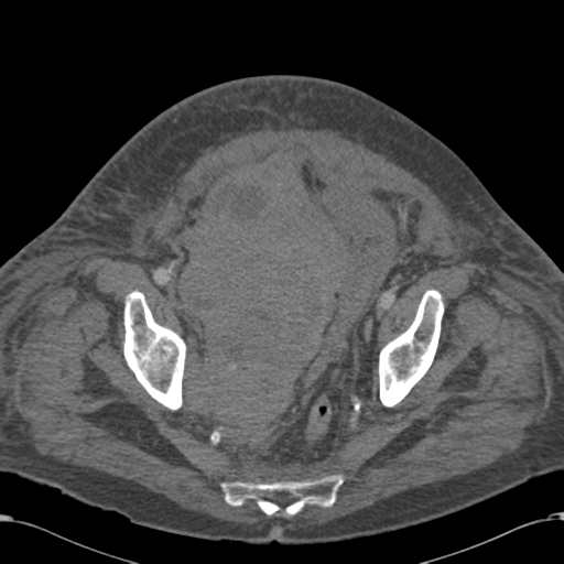 Abdominal hematoma (Radiopaedia 33614-34715 Axial C+ portal venous phase 114).png