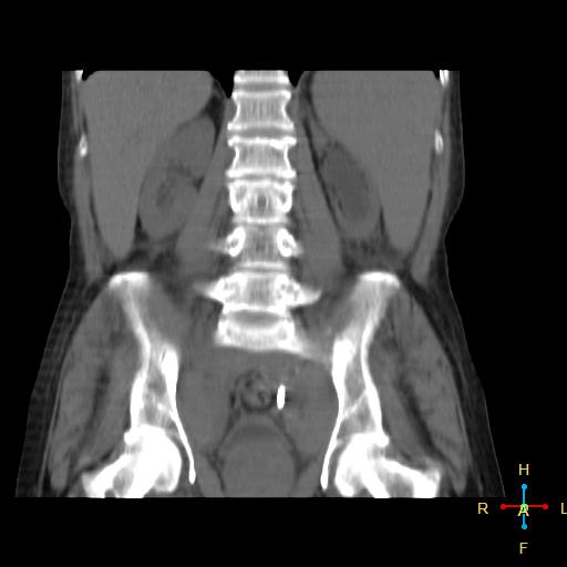 File:Abdominal lymphoma (Radiopaedia 23085-23115 Coronal non-contrast 7).jpg