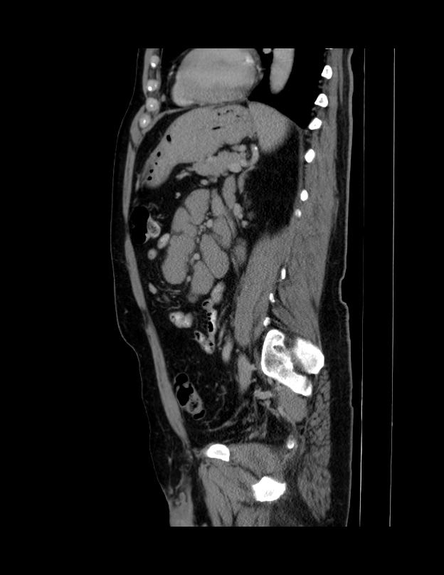 Abdominal lymphoma - with sandwich sign (Radiopaedia 53486-59492 Sagittal C+ portal venous phase 29).jpg