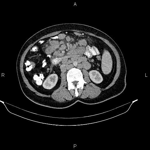 Abdominal lymphoma with sandwich sign (Radiopaedia 84378-99704 Axial C+ portal venous phase 29).jpg