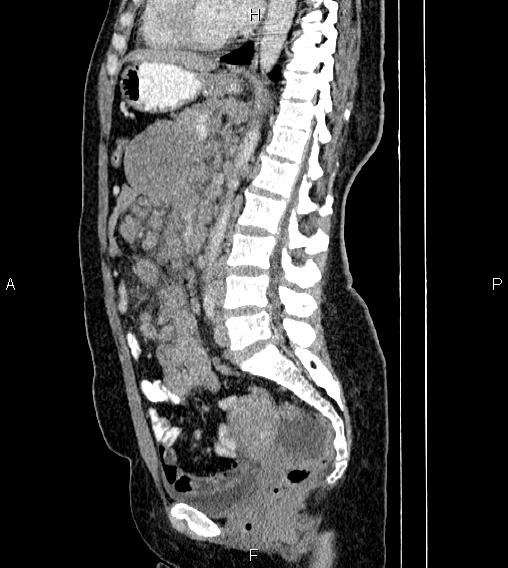 Abdominal lymphoma with sandwich sign (Radiopaedia 84378-99704 Sagittal C+ portal venous phase 50).jpg