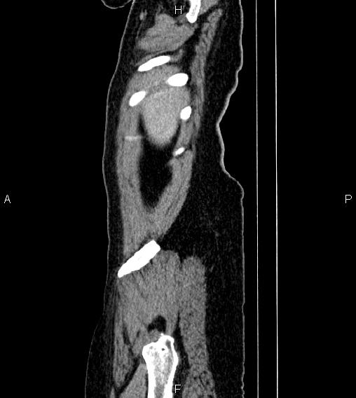 Abdominal lymphoma with sandwich sign (Radiopaedia 84378-99704 Sagittal C+ portal venous phase 90).jpg