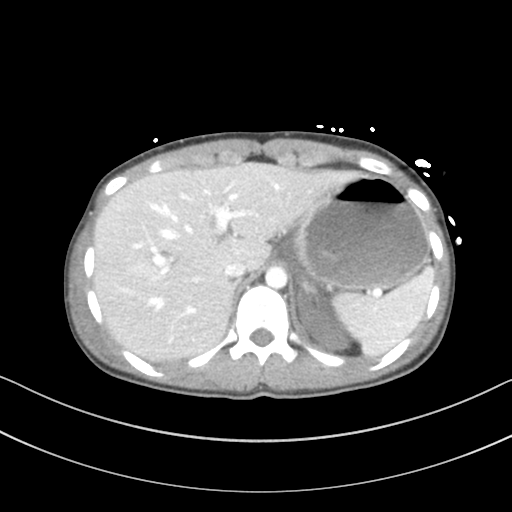 Abdominal multi-trauma - devascularised kidney and liver, spleen and pancreatic lacerations (Radiopaedia 34984-36486 Axial C+ portal venous phase 16).png