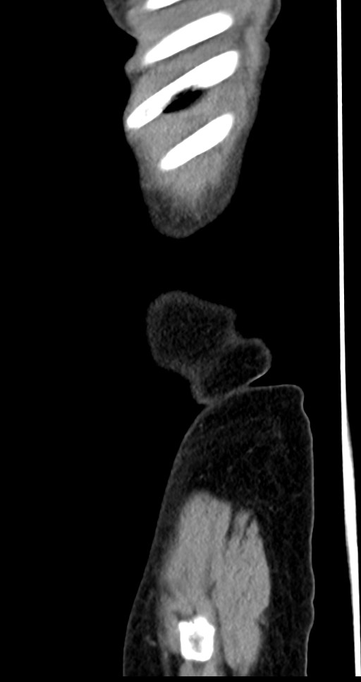 Abdominal wall and retroperitoneal tuberculosis (Radiopaedia 88137-104729 Sagittal C+ portal venous phase 143).jpg