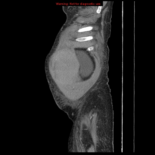 Abdominal wall hematoma (Radiopaedia 9427-10112 Sagittal C+ portal venous phase 101).jpg