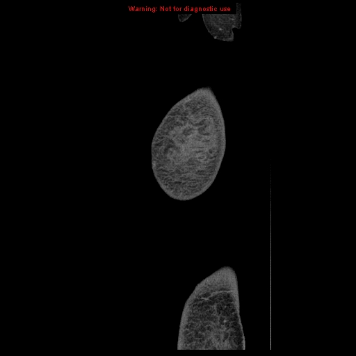 Abdominal wall hematoma (Radiopaedia 9427-10112 Sagittal C+ portal venous phase 114).jpg