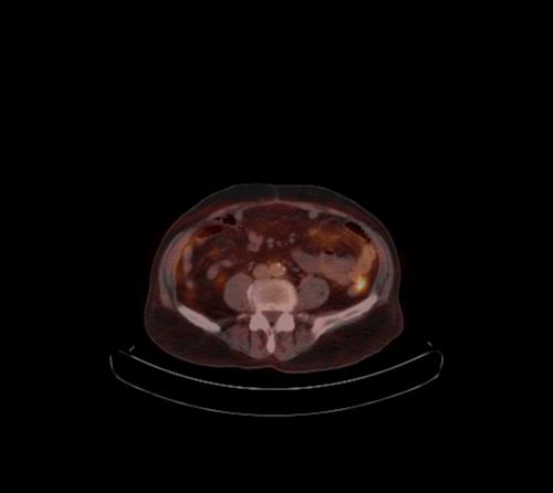 Abdominal wall metastasis from colorectal carcinoma (Radiopaedia 31016-31719 C 52).jpg