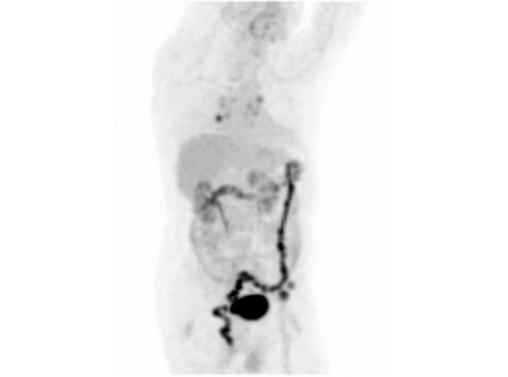 File:Abdominal wall metastasis from colorectal carcinoma (Radiopaedia 31016-31719 Rotational MIP 28).jpg