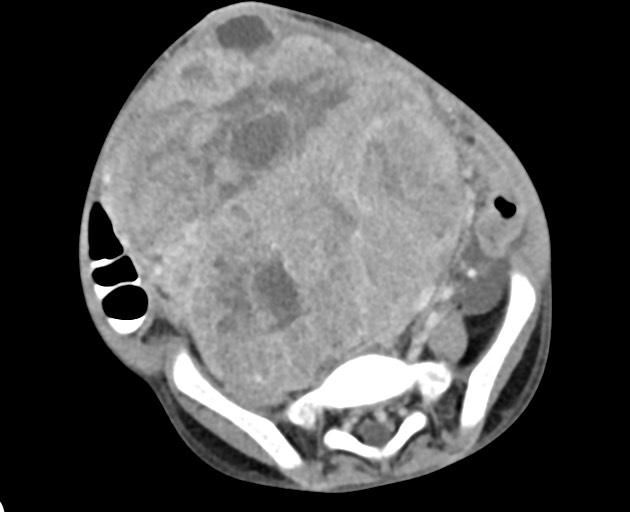 Abdominopelvic rhabdomyosarcoma (Radiopaedia 78356-90984 Axial C+ portal venous phase 119).jpg