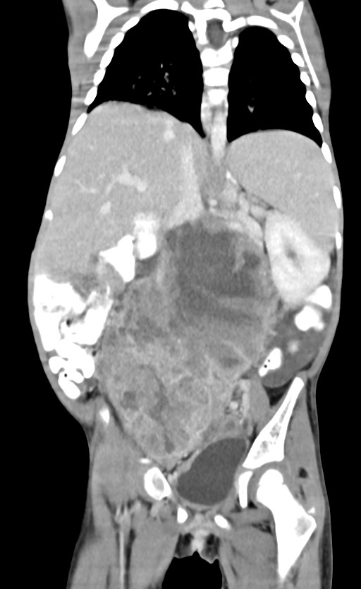 Abdominopelvic rhabdomyosarcoma (Radiopaedia 78356-90984 Coronal C+ portal venous phase 57).jpg
