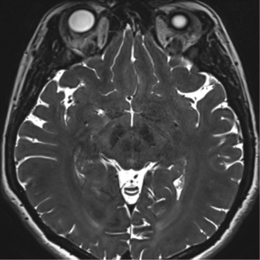 Abducens nerve palsy (Radiopaedia 51069-56648 Axial T2 fat sat 79).png