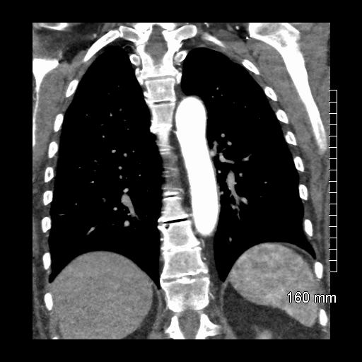 Aberrant right subclavian artery stenosis (Radiopaedia 52656-58670 B 61).jpg