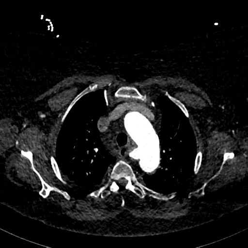 Aberrant right subclavian artery with Kommerell diverticulum (Radiopaedia 47982-52769 Axial C+ arterial phase 25).png