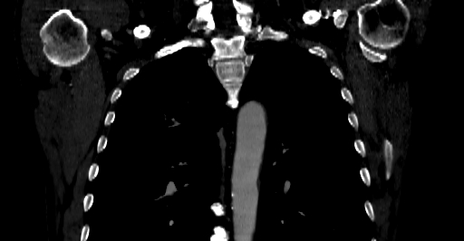 Accesory rib joint (Radiopaedia 71987-82452 Coronal bone window 14).jpg
