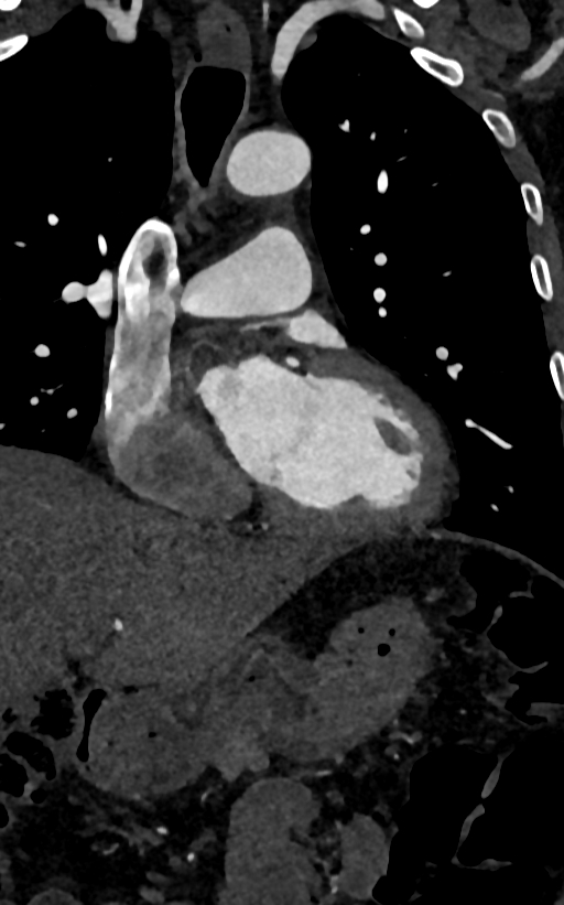 Accessory left atrial appendage (Radiopaedia 81987-95968 Coronal C+ arterial phase 48).jpg