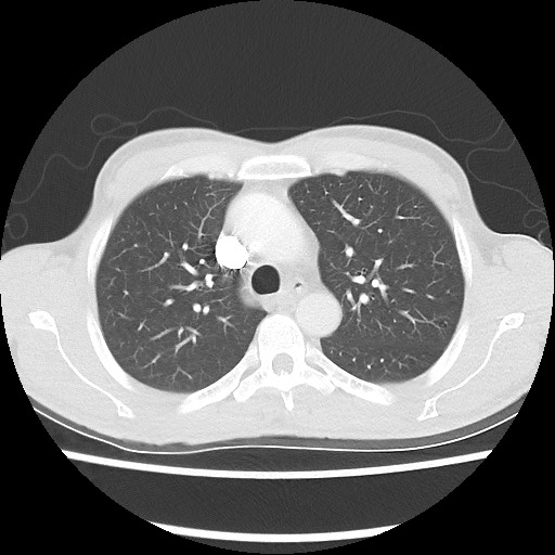 Accessory left horizontal fissure with lingular pneumonia (Radiopaedia 53763-59843 Axial lung window 20).jpg