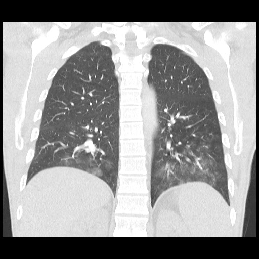 Accessory left horizontal fissure with lingular pneumonia (Radiopaedia 53763-59843 Coronal lung window 32).jpg