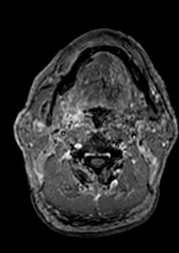 Accessory middle cerebral artery (Radiopaedia 73114-83828 Axial T1 C+ 288).jpg