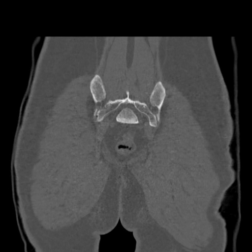 File:Acetabular and ilial fractures (Radiopaedia 59084-66378 Coronal bone window 50).jpg