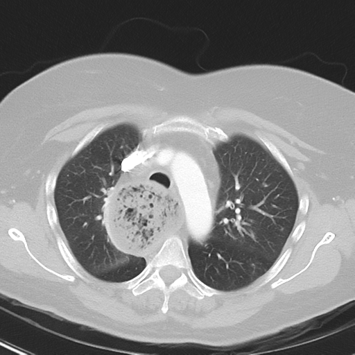 File:Achalasia (Radiopaedia 47147-51685 Axial lung window 16).png
