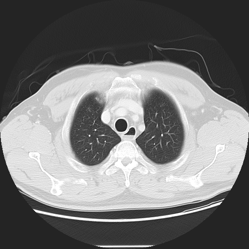 Achalasia (Radiopaedia 8831-9629 Axial lung window 16).jpg