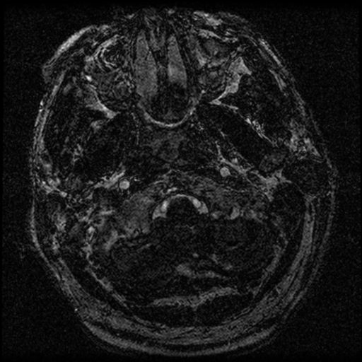 File:Acoustic schwannoma (Radiopaedia 39170-41387 Axial FIESTA 7).png