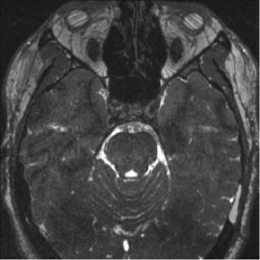 Acoustic schwannoma (translabyrinthine resection) (Radiopaedia 43570-46972 Axial CISS 50).png