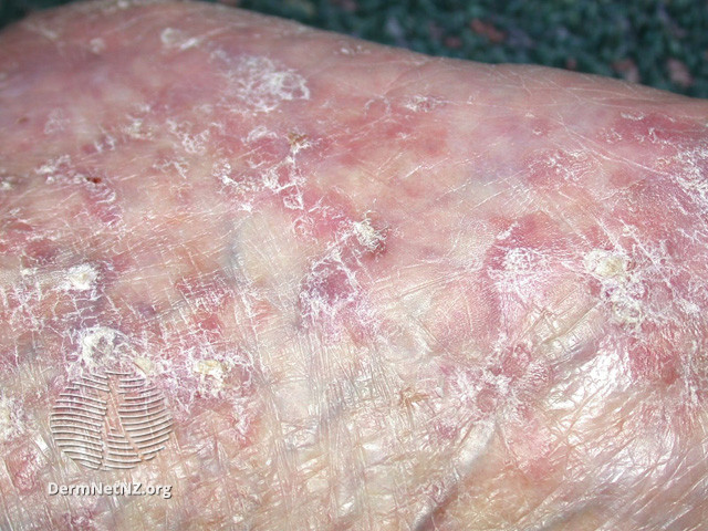 File:Actinic keratoses affecting the legs and feet (DermNet NZ lesions-ak-legs-476).jpg