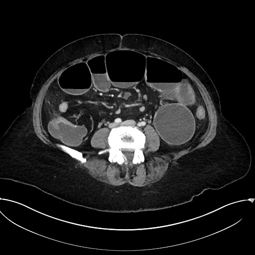 Active Crohn disease (Radiopaedia 59394-66750 Axial C+ portal venous phase 45).jpg
