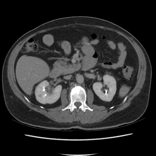 File:Active colonic bleed on CT (Radiopaedia 49765-55025 Axial C+ delayed 33).jpg