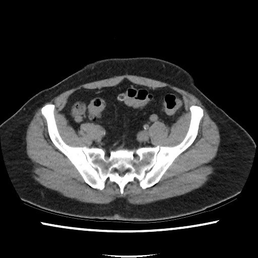 Active colonic bleed on CT (Radiopaedia 49765-55025 Axial non-contrast 64).jpg