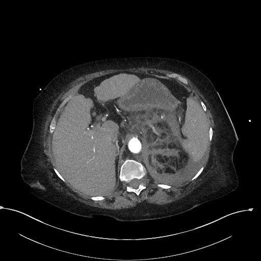 File:Active renal extravasation with large subcapsular and retroperitoneal hemorrhage (Radiopaedia 60975-68796 Axial C+ arterial phase 50).jpg