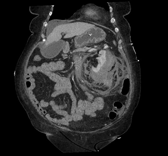 File:Active renal extravasation with large subcapsular and retroperitoneal hemorrhage (Radiopaedia 60975-68796 Coronal C+ portal venous phase 51).jpg
