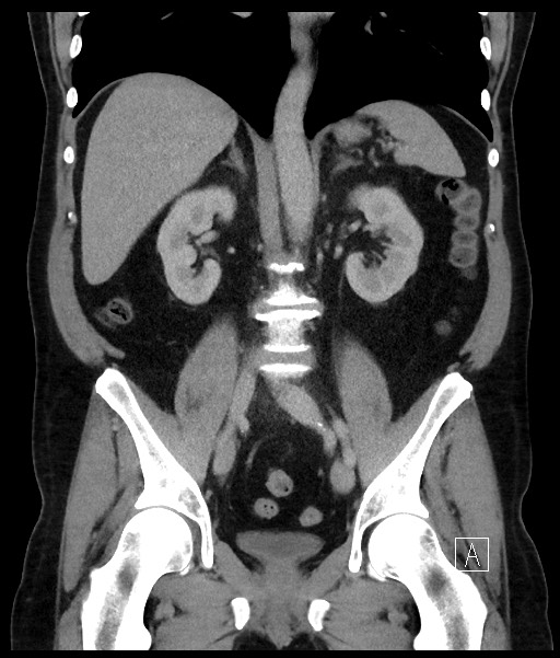 Acute-on-chronic pancreatitis (Radiopaedia 67286-76656 Coronal C+ portal venous phase 46).jpg