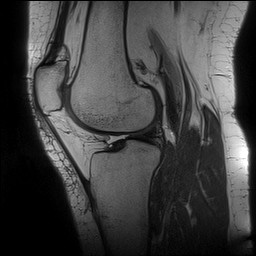 Acute-on-chronic transient lateral patellar dislocation with trochlear dysplasia (Radiopaedia 84099-99349 Sagittal PD 95).jpg
