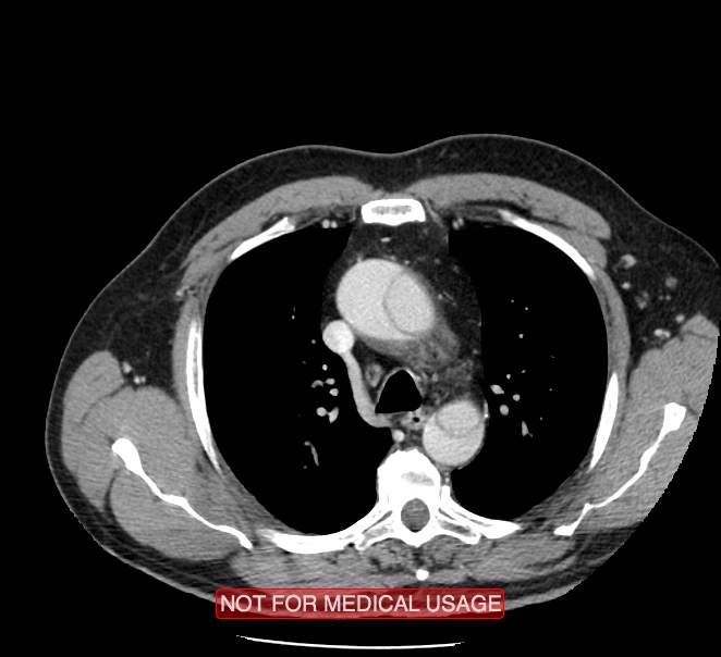 Acute aortic dissection - Stanford type A (Radiopaedia 40661-43285 Axial C+ portal venous phase 10).jpg