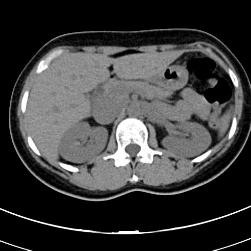 Acute appendicitis (Radiopaedia 30261-30888 Axial non-contrast 16).jpg