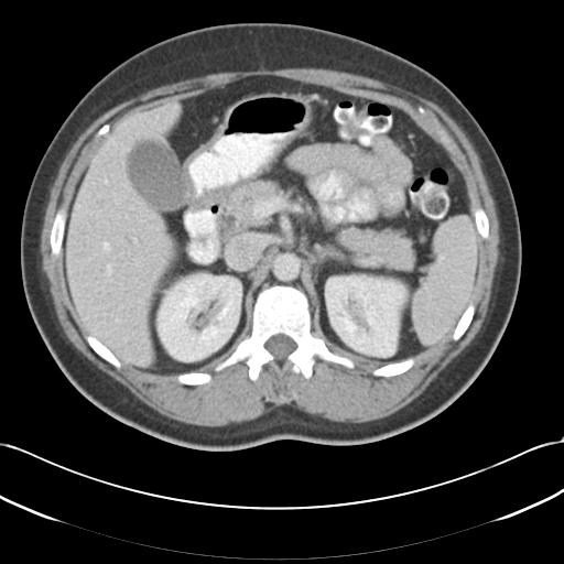 File:Acute appendicitis (Radiopaedia 30297-30934 Axial C+ portal venous phase 25).jpg