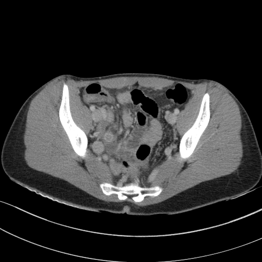 File:Acute appendicitis (Radiopaedia 62608-70901 Axial C+ portal venous phase 32).jpg