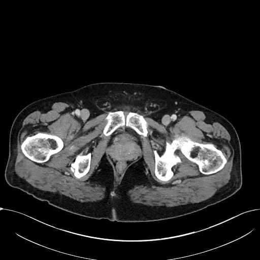 File:Acute appendicitis - large appendicoliths (Radiopaedia 61805-69820 Axial C+ portal venous phase 133).jpg