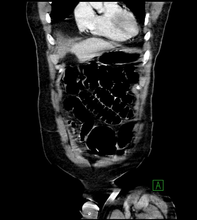 Acute arterial mesenteric ischemia (Radiopaedia 78238-90828 Coronal C+ portal venous phase 24).jpg