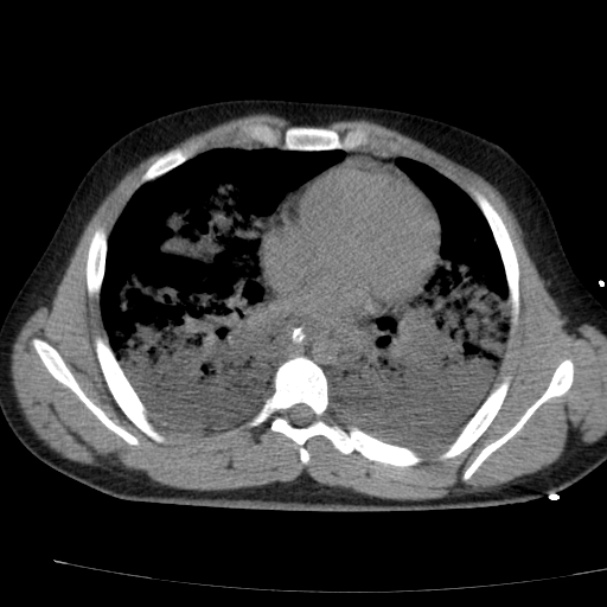 Acute aspiration pneumonitis (Radiopaedia 33605-34703 Axial non-contrast 52).jpg