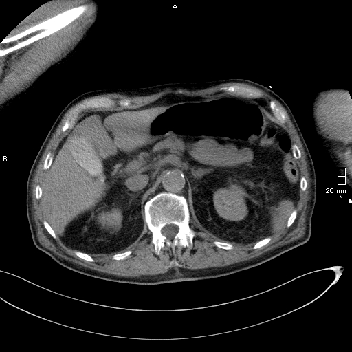 Acute aspiration pneumonitis (Radiopaedia 55642-62166 Axial liver window 64).jpg