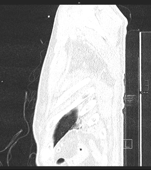 File:Acute aspiration pneumonitis (Radiopaedia 55642-62166 Sagittal lung window 2).jpg