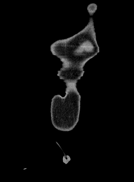 Acute bowel ischemia (Radiopaedia 87695-104114 Coronal C+ portal venous phase 53).jpg
