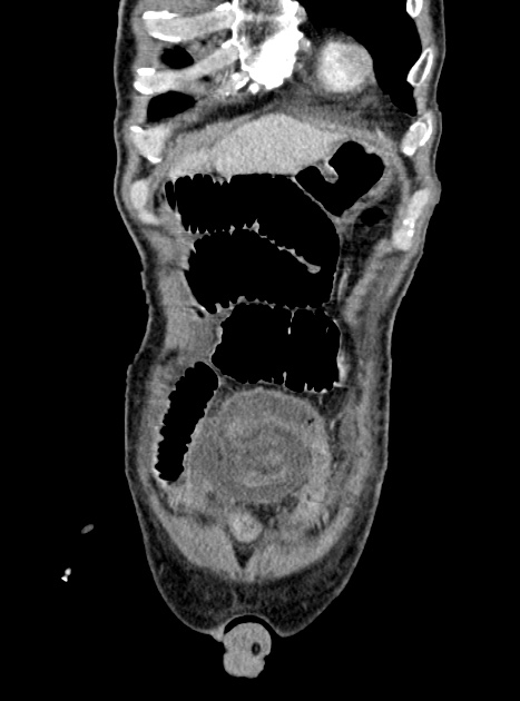 Acute bowel ischemia (Radiopaedia 87695-104114 Coronal C+ portal venous phase 94).jpg