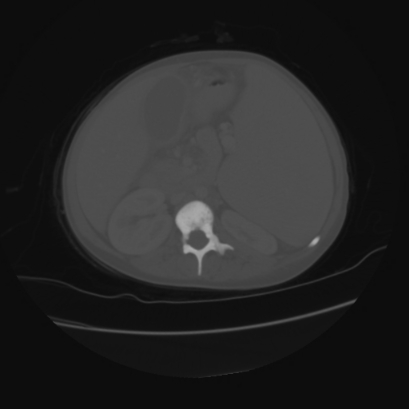 Acute calculous cholecystitis in patient with osteopetrosis (Radiopaedia 77871-90159 Axial bone window 22).jpg