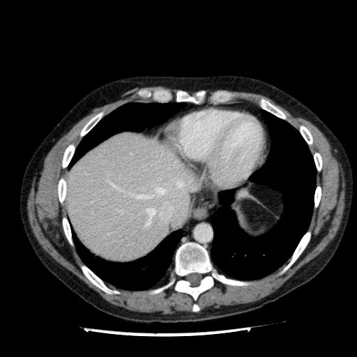 Acute cholecystitis and incidental left sided IVC (Radiopaedia 49352-54459 Axial C+ portal venous phase 26).jpg