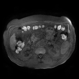 Acute cholecystitis complicated by pylephlebitis (Radiopaedia 65782-74915 Axial T1 fat sat 73).jpg